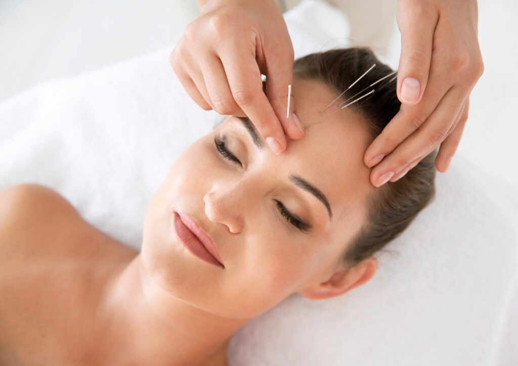 Lifting facial con acupuntura