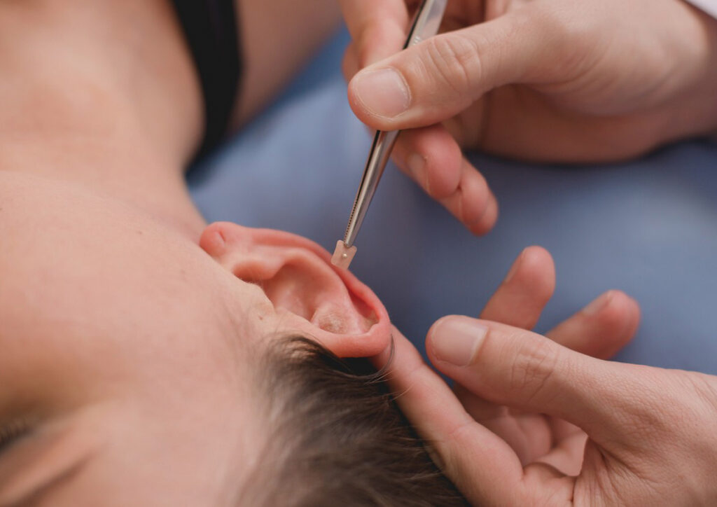 terapia de auriculoterapia