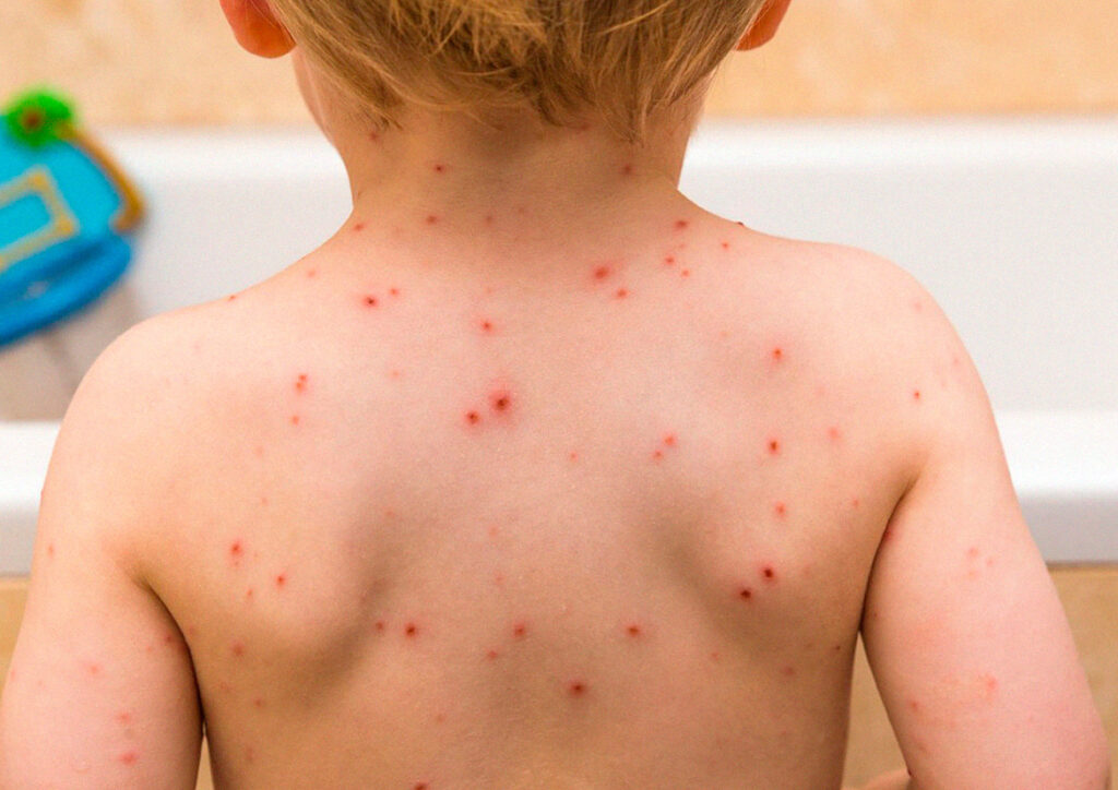 Varicela zóster, no solo es cosa de niños